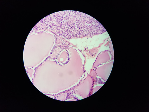 Parathyroid Thyroid Slides - Parathyroid_Thyroid 007 400X